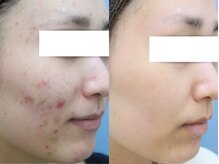 長年悩んでいた肌荒れもEpiaのニキビケアで肌改善に導きます！