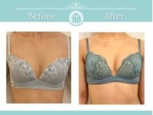 美人バスト 新潟店/ 【バストアップ★育乳】症例