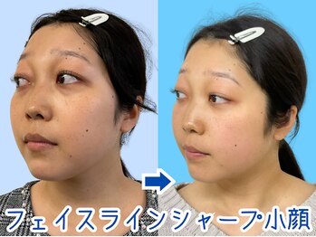 ナチュラルパーフェクトフェイス 新宿/むくみ・フェイスライン新宿小顔