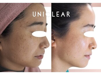 ユニクリア 佐賀(Uniclear)の写真/今の自分が好き★超美肌【大人肌のハーブピーリング+プラズマ+選べる美容アンプル導入】3ステップ完結版