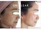 ユニクリア 佐賀(Uniclear)の写真/今の自分が好き★超美肌【大人肌のハーブピーリング+プラズマ+選べる美容アンプル導入】3ステップ完結版