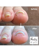 パスリー ネイルアンドケア(Parsley Nail&Care)/巻き爪補正は事前にご確認下さい