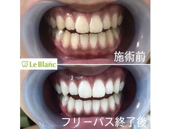 ルブラン 奈良店(Le Blanc)/歯が白くなると嬉しい!楽しい♪