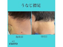 アクト クロ(ACT curro)/【うなじ襟足】脱毛施術例