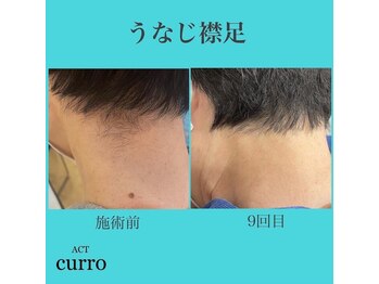 アクト クロ(ACT curro)/【うなじ襟足】脱毛施術例