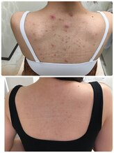 ビエル(Bielle)/身体のアクネケア