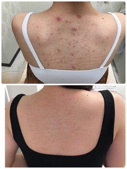 ビエル(Bielle)/身体のアクネケア