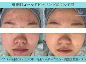 リメイククリニカルビューティー(Remake clinical beauty)/【施術症例】幹細胞GP