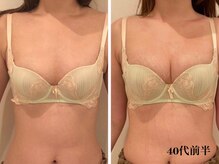 リール 新宿店(RIRE)/40代前半　 バストアップ症例