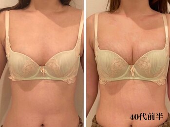 リール 新宿店(RIRE)/40代前半 バストアップ症例