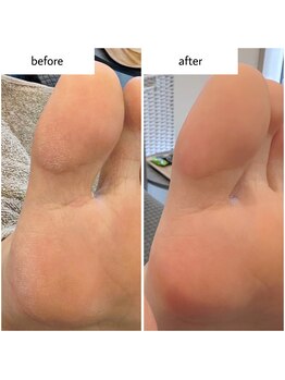 ケアプラス(care plus)/足裏角質ケア