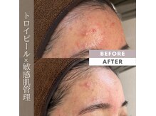 スウィート 矢場町店(Sweet)の雰囲気（敏感/ニキビ/しみ/シワたるみ/トラブルどんな肌もお任せ下さい！）