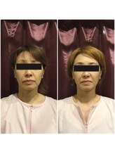 世田谷ビューティークリニーク 池尻大橋/小顔矯正の効果♪