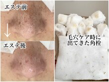 ニュートラル(neutral)/【毛穴エステ】毛穴の詰まり除去