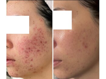 ハクビューティー(HAKU BEAUTY)/ニキビ