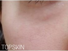トップスキン 新宿(TOPSKIN)/30代のお客様／目の下のたるみ