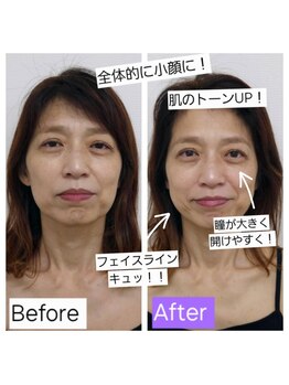 ハリ ヴァカンス(Hari Vacances)/オーダーメイド式美容鍼