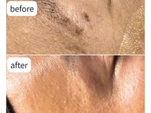 カシェット(Cachette)/40代男性COCOREGEN シミケア60分