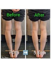 クシロ鍼灸整骨院/【O脚矯正】施術例