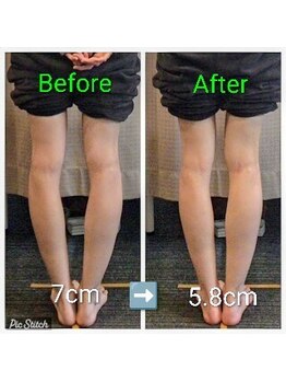 クシロ鍼灸整骨院/【O脚矯正】施術例