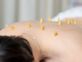 溝口鍼灸整骨院/灸施術