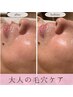 【初回】ニキビケア・しみ予防！マイクロニードルピーリング60分¥5500