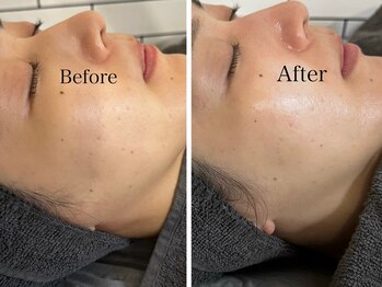 シード(SHE°)/ハーブピーリング(お顔)