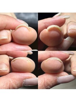 マニュコクーン(ManuCocoon)/爪育成 深爪 巻き爪 大阪