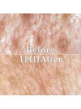 ミニョスキンラボ/韓国式ハーブピーリング1回