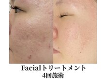 アムリリー 南草津店(AMRILY)/肌質改善