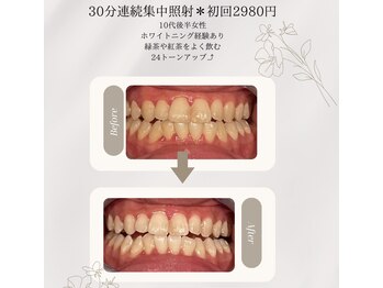 プラスビーセルフ(+b self)/ホワイトニングビフォーアフター