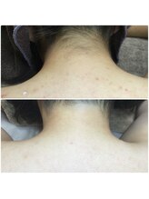 カルム(Calme)/うなじ・背中脱毛