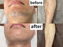 アレッド 大阪店(ared.)/すね毛脱毛3回施術後