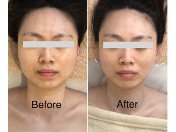 ミピマムマリール(Mipimam Marire)/Before、After