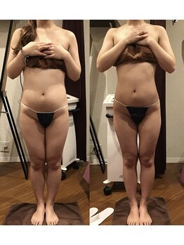 エスプレッソ(espresso,)/【半身痩身5回】体重-4.2kg