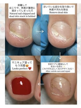 ネイルズ バイ ユイ 外苑前(Nails by Yui)/剥離した爪の補強