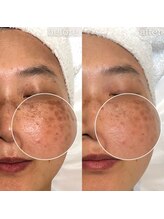 エステティックサロン ナチュラーレ/シミ・くすみ・小ジワ