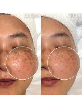 エステティックサロン ナチュラーレ/シミ・くすみ・小ジワ