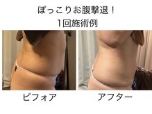 ニコ(NIKO)/グロッティプロスリム施術例