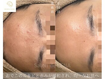 サロンドレナ 名駅店/ハーブピーリング サロンドレナ