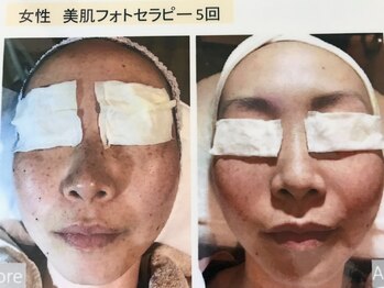 セルエス(sels)/光フェイシャル