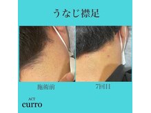 アクト クロ(ACT curro)/【うなじ襟足】脱毛施術例