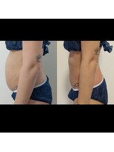 ホワイトビューティーラボ(White Beauty Lab)/【痩身】腹部集中モニター