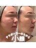【SNSで話題】東海地方希少！美顔筋テラボーラー《初回価格》