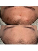 タリア(TALIA)/ニキビができにくくなった！