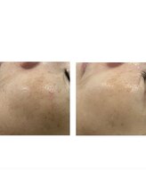 ラメール(La_mer)/【セラピール】シミのお悩みにも