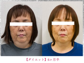 ボディメイク アールエフ サクラ接骨院(bodymake RF SAKURA接骨院)/50代　ダイエットコース効果