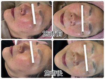 パール(PEARL)/優しいハーブピーリング