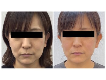 かとう鍼灸整骨院/◆40代女性　１０回の施術例