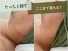 【定番の速攻小顔＆後戻りなし】針を使わない脂肪分解 小顔フェイシャル 5ml 